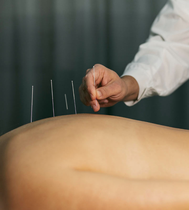 Acupuncture